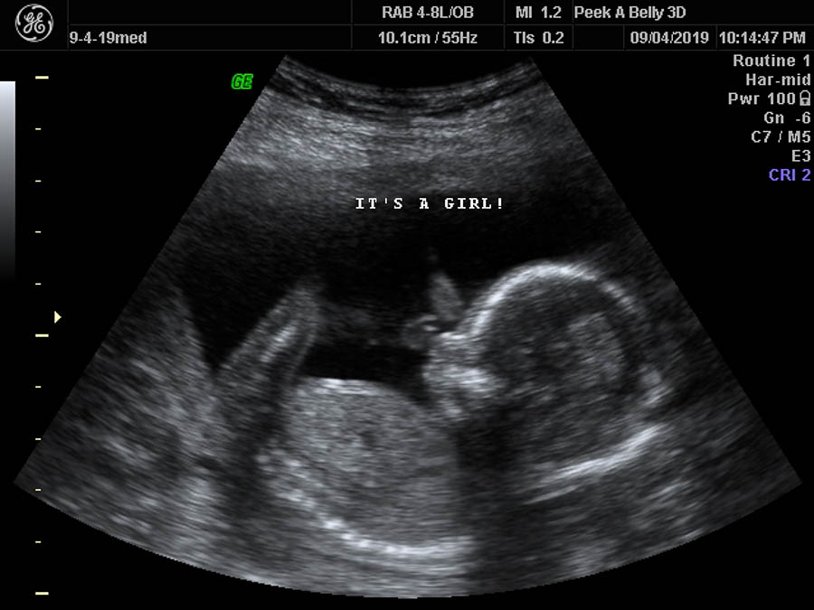 Ultrasound picture of a 16 week old baby